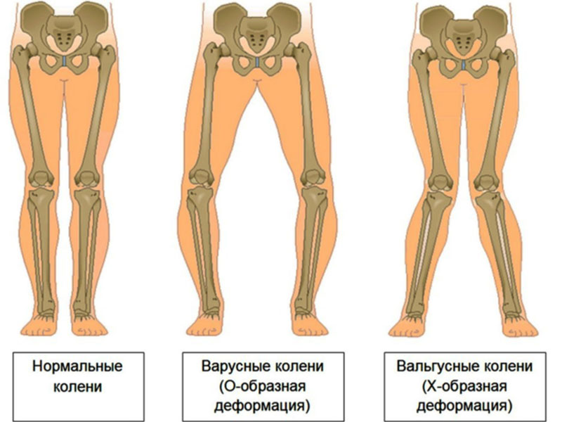 Виды коленей при плоскостопии