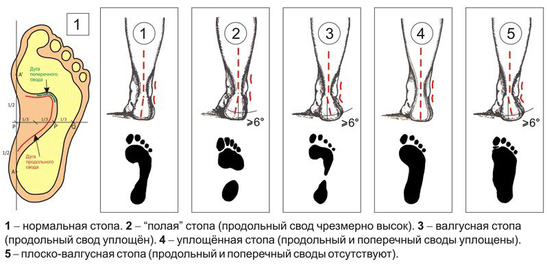 Картинки на тему плоскостопие